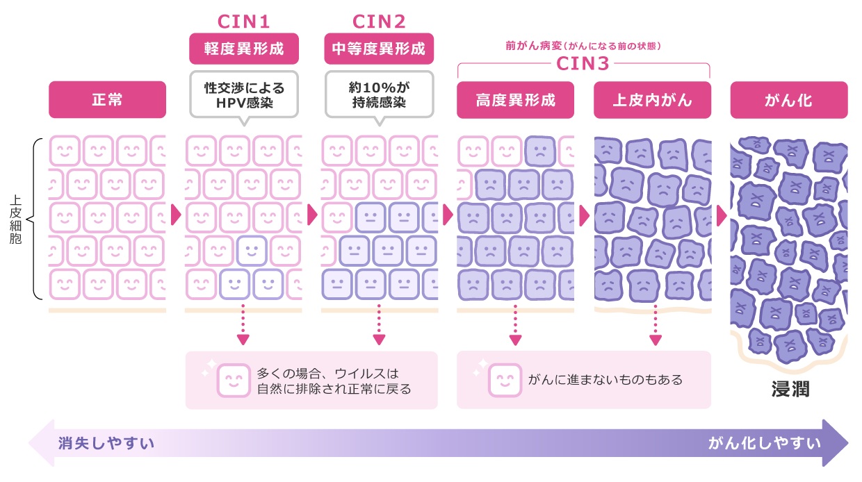 表：上皮細胞 | 正常→CIN1 - 軽度異形成 - 性交渉によるHPV感染（多くの場合、ウイルスは自然に排除され正常に戻る）→CIN2 - 中等度異形成 - 約10%が持続感染（多くの場合、ウイルスは自然に排除され正常に戻る）→高度異形成（がんに進まないものもある）→上皮内がん（がんに進まないものもある）→がん化（浸透）| 正常なほど - 消失しやすい～がん化にいくほど - がん化しやすい